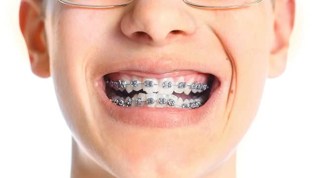 A close up of the teenager wearing braces
