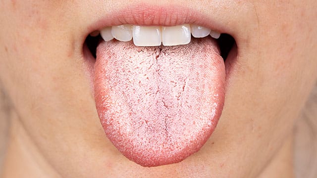 A close up of the white tongue