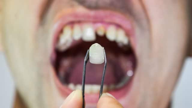 dental-prosthesis-metal-ceramics-tweezers-patient