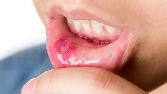 Afta bucal en la parte interna del labio
