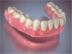 conventional dentures - colgate in