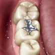 silver amalgam dental filling - colgate in
