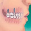 Los implantes sirven como base para los dientes de reemplazo