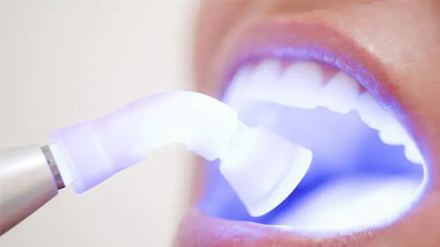 Teeth whitening procedure with a laser