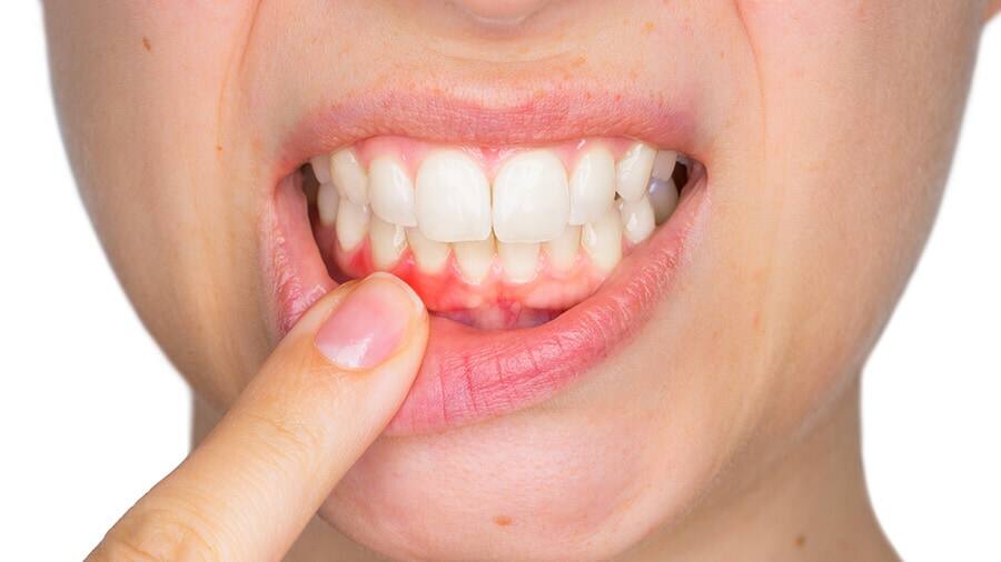 Close-up of a women pointing to red, swollen gums, a common symptom of gum disease.