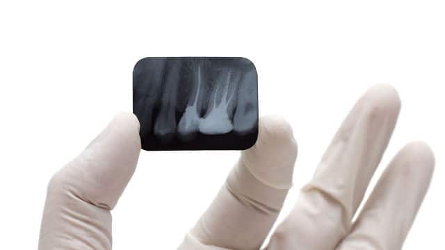 Dental X-Ray