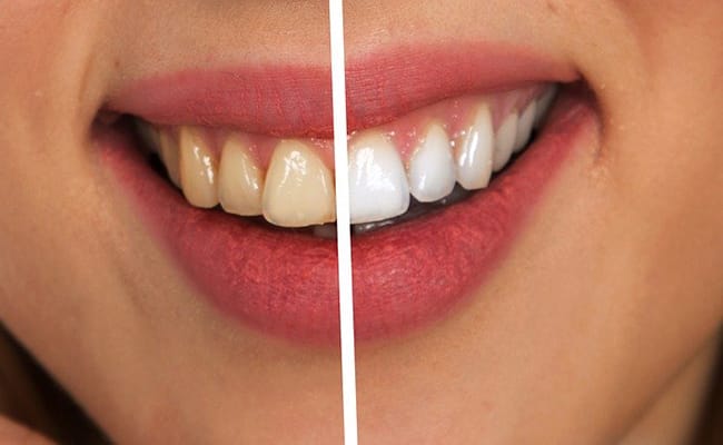 Kadının beyazlatma tedavisinden önce ve sonra gülümsemesi