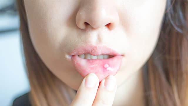 Aftas en la garganta: lesión en amígdala y cómo aliviarlas Ej de imagen