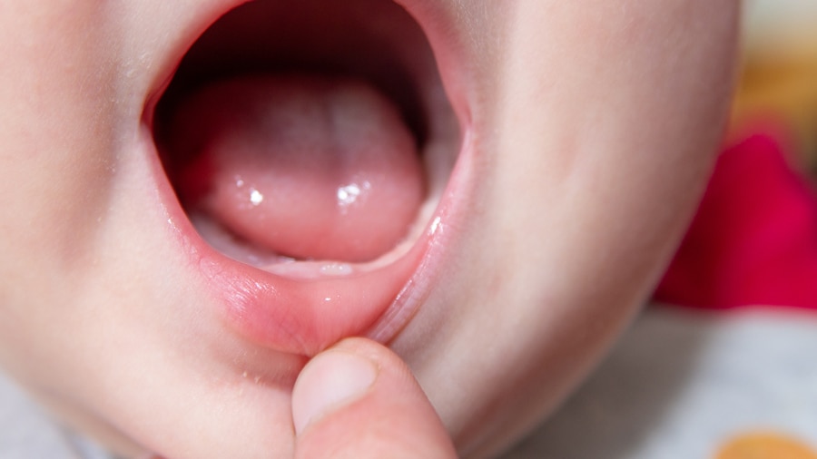 تسوس اسنان الاطفال