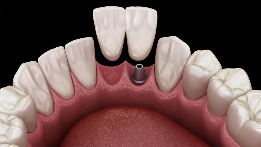 فوائد واضرار جسر الاسنان