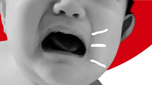 Oral Thrush