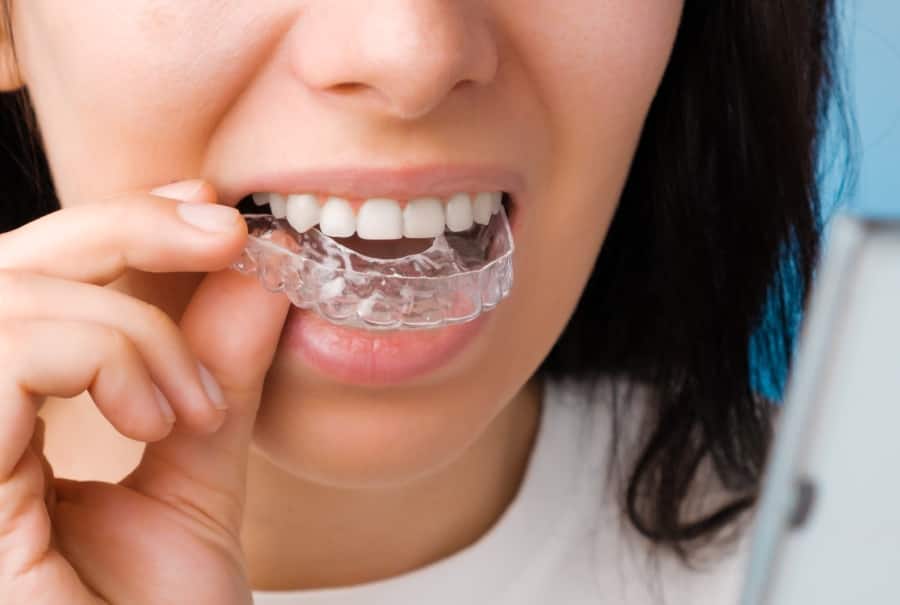 how does a retainer work - colgate india