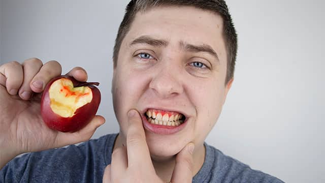 Inflamación gingival
