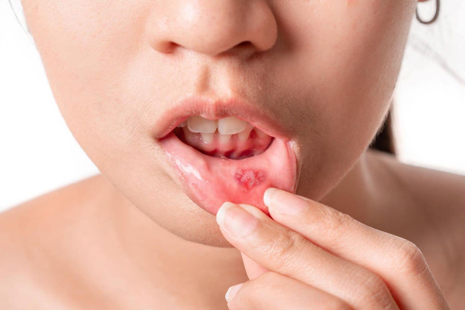 mouth-canker-sore-close-up