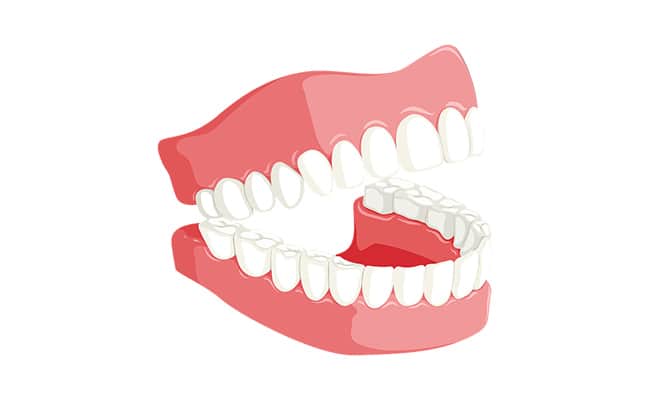 Diş etlerinin çekildiğini gösteren çizim