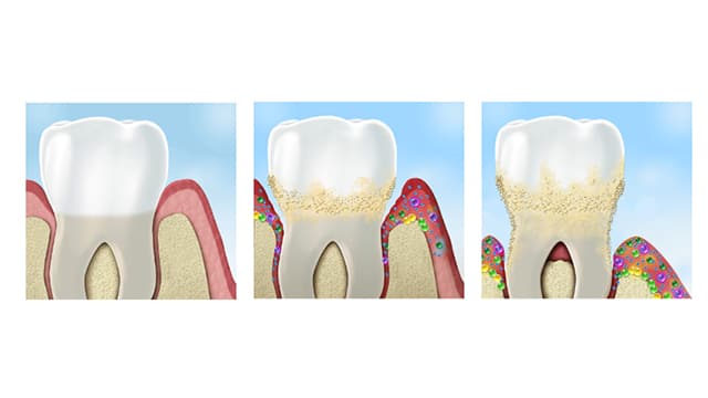 Periodontal disease a recap