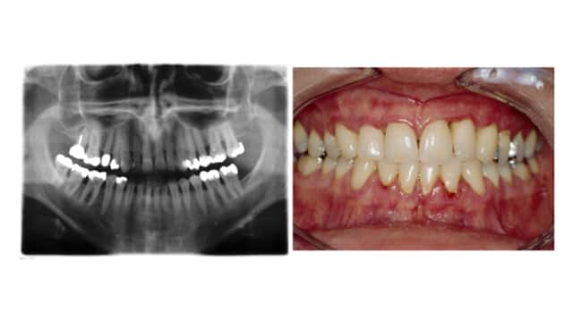 periodontitis