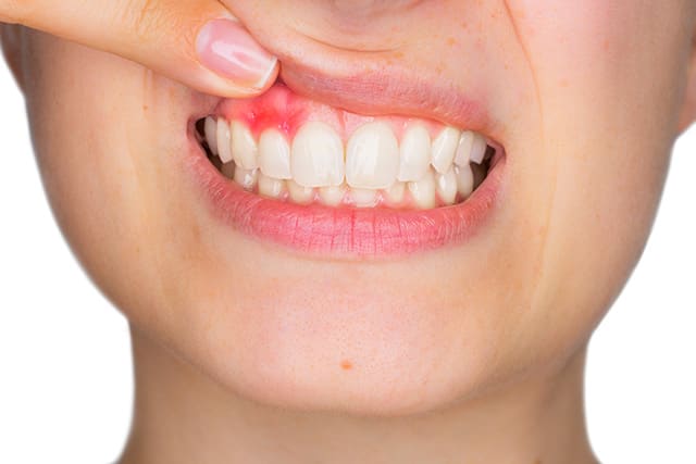 Sonrisa con un dedo que levanta el labio superior