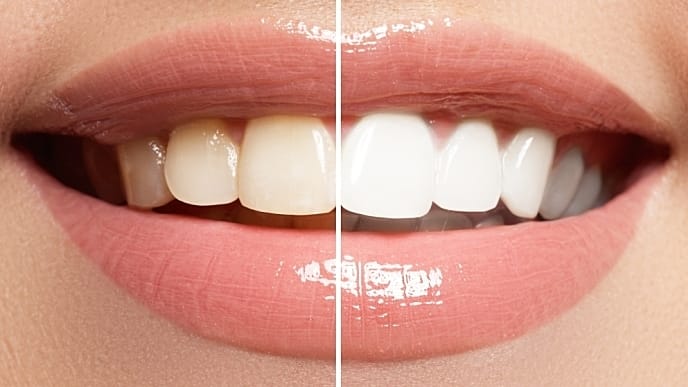 teeth whitening before and after