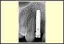 SingleToothImplants2