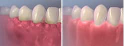 Gingivoplasty
