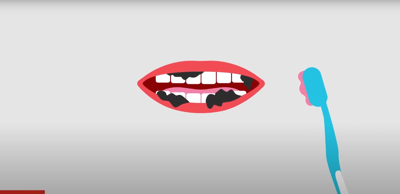Does Charcoal Teeth Whitening Work?