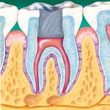 Cámara dental sellada