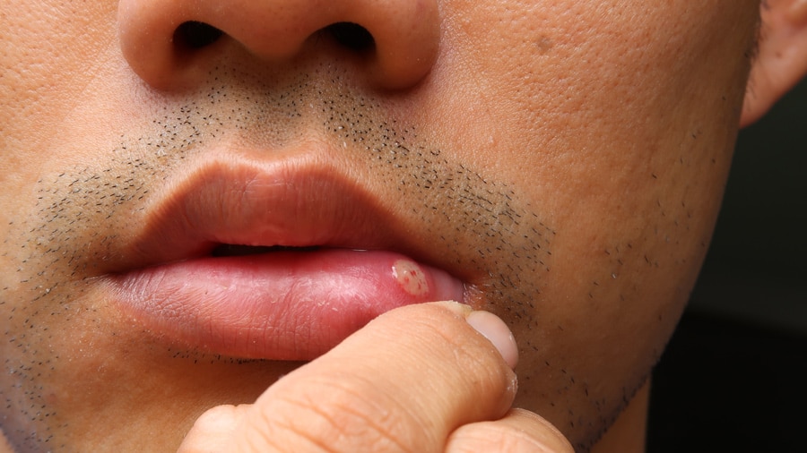 How to cure oral thrush?