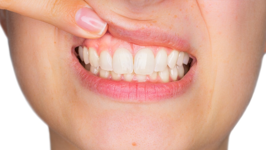 Woman examining her gums after using swollen gum home remedy