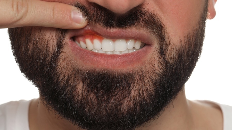 A man showing his gums to explain black gum reasons