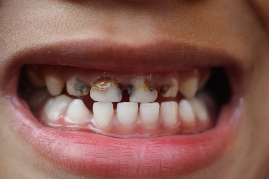 caries dental infantil