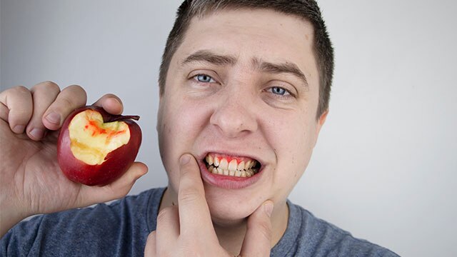 Inflamación gingival