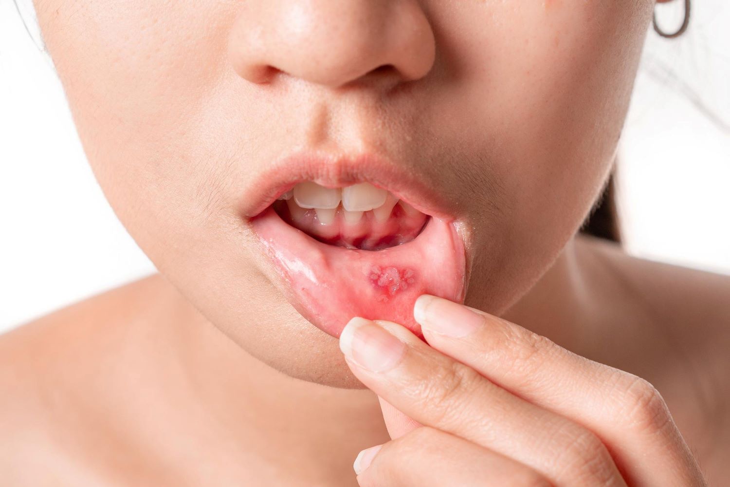 mouth-canker-sore-close-up