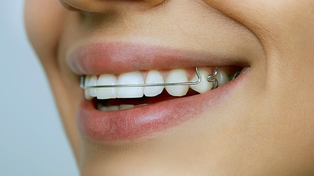 Dientes perfectos con retenedores temporales