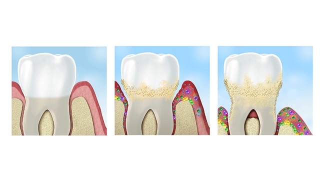 Periodontal disease a recap