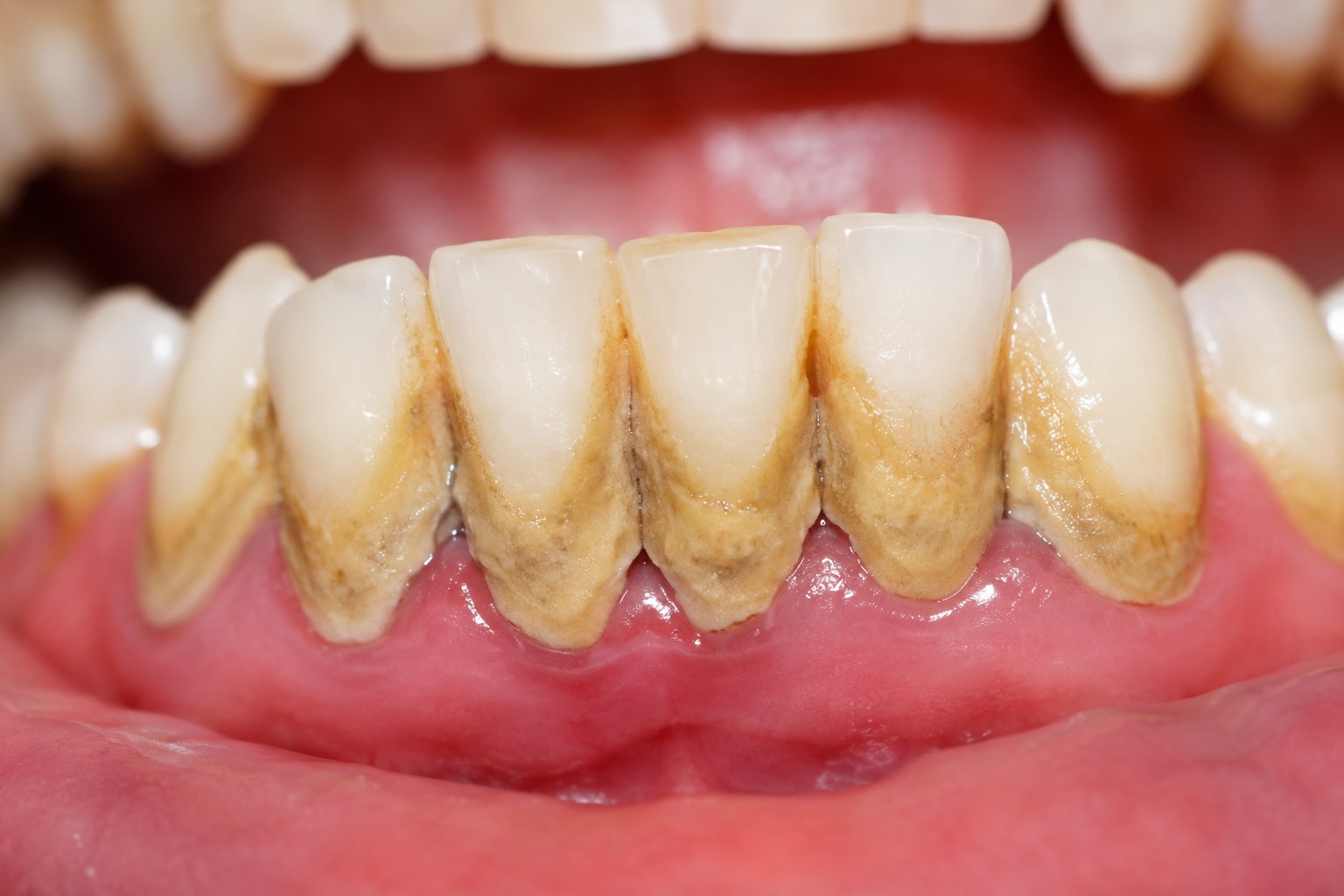 como-quitar-sarro-dientes
