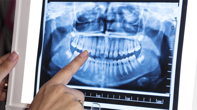 Radiografia de Dientes
