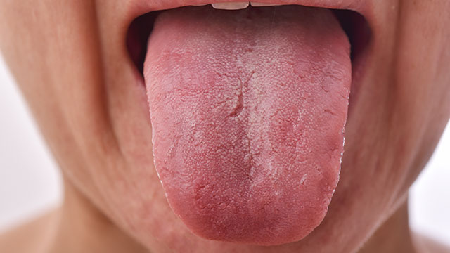 Lengua fisurada