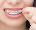 Young woman applying wax to her braces