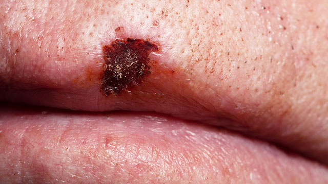 cáncer de labio