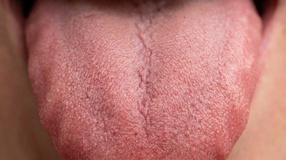 Acercamiento de la superficie dorsal de una lengua sana donde se distinguen claramente las papilas filiformes cubriendo los dos tercios anteriores.