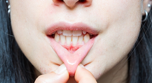 Alt dudağını çekerek alt çene ön dişlerini ve labial frenulum dokusunu gösteren kadın.