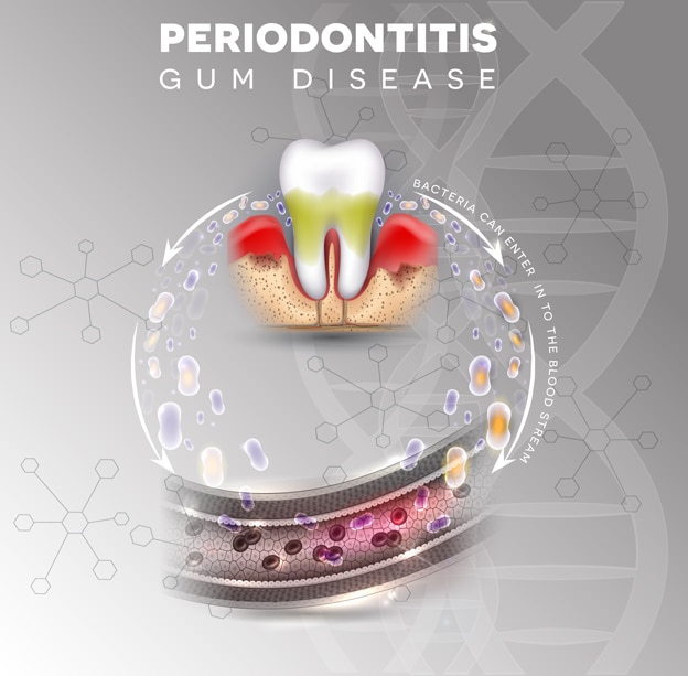 Periodontitis diş eti hastalığında bakterilerin kan dolaşımına geçişini gösteren tıbbi illüstrasyon
