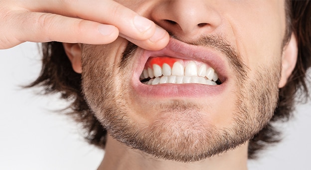 Diş Eti Çekilmesine Ne İyi Gelir? Nedenleri, Belirtileri ve Önleme Rehberi