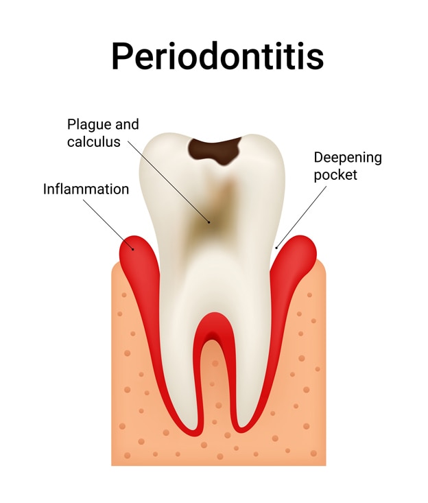 Periodontitis hastalığında iltihap, plak, diş taşı ve cep derinleşmesini gösteren diş diyagramı