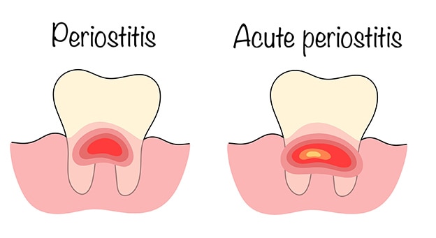 Periodontitis Nedir? Belirtileri, Türleri ve Gingivit Farkı