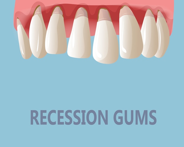 Diş eti çekilmesi gösteren diş illüstrasyonu ve RECESSION GUMS yazısı