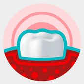 gingivitis