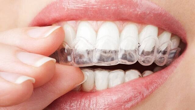 woman putting in teeth whitening tray