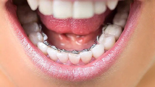 person with lingual braces